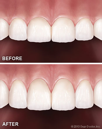 Photo of Before and After Gum Grafting