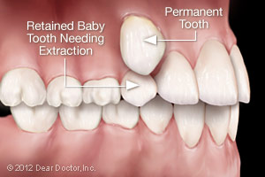 Photo of Wisdom Teeth Extraction